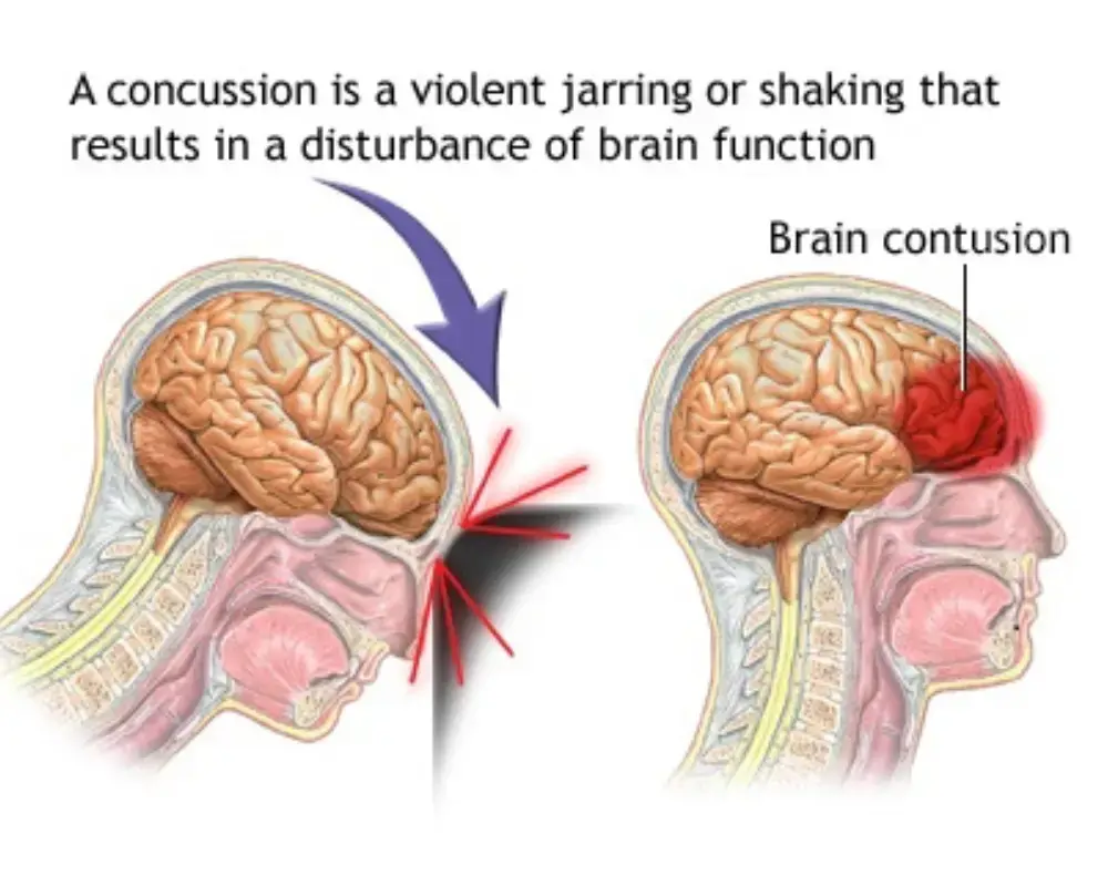 Post concussion syndrome