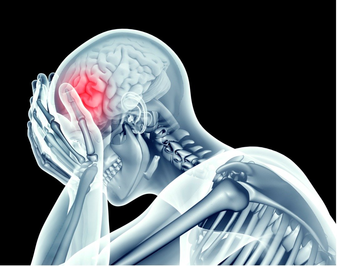 Post Concussion Syndrome
